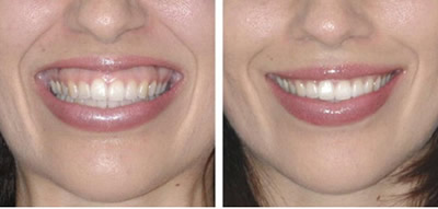 Botox