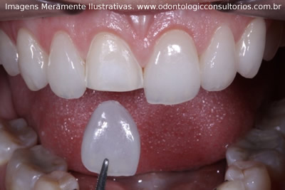 Facetas Laminadas